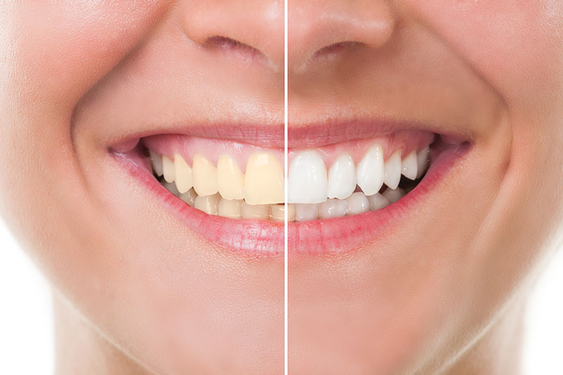 Teeth Whitening - Cosmetic & Family Dentistry, San Diego Dentist